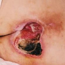 Odleżyny_html_m5d23c482